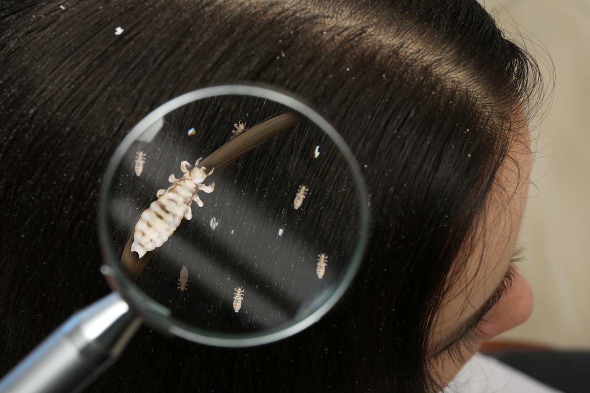 Closeup of Woman with Dandruff in Her Hair, View through Magnify